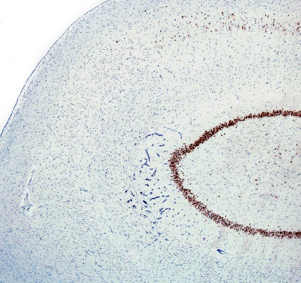 3C2 Hypoxia-Ischemia, Sommer's (Case 3) NeuN 1