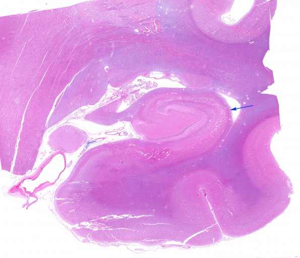 4B1 Hypoxia-Ischemia, subacute (Case 4) H&E whole mount 2 copy