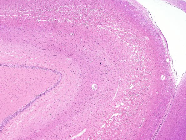 4B2 Hypoxia-Ischemia, subacute (Case 4) H&E 3