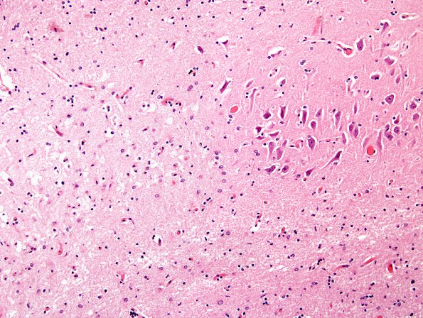 5A3 Hypoxia-Ischemia (Case 5) HC 3 (2)