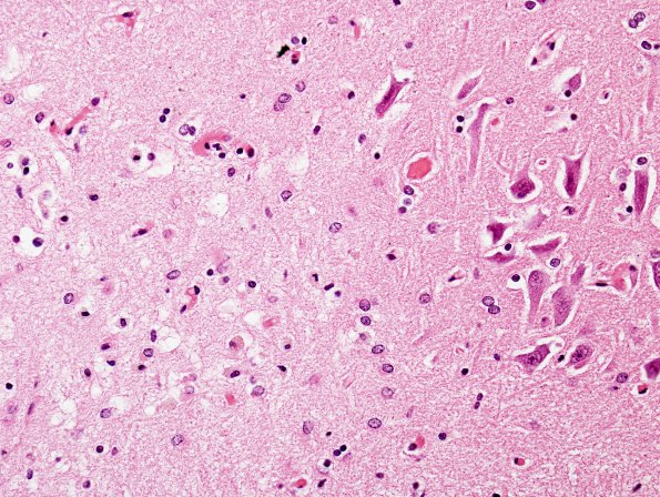 5A4 Hypoxia-Ischemia (Case 5) HC 2