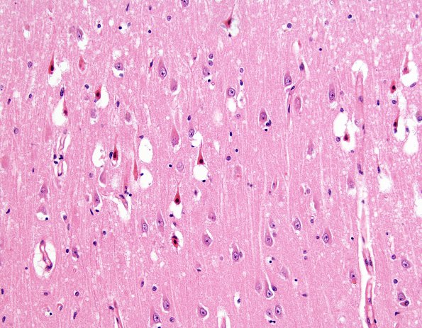 6A1 Hypoxia-Ischemia, adult, hippocampus (Case 6) H&E 2