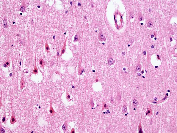 6A2 Hypoxia-Ischemia, adult, hippocampus (Case 6) H&E 5