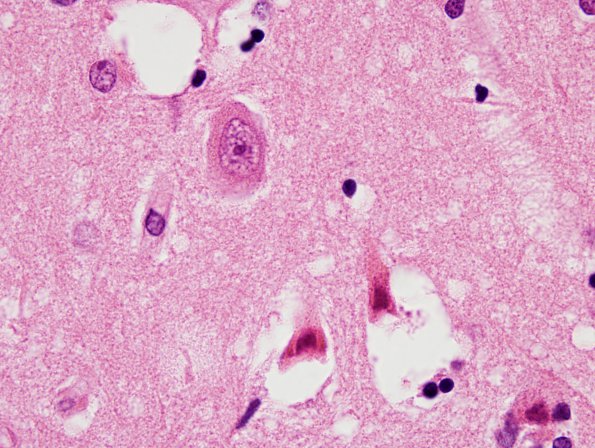 6A3 Hypoxia-Ischemia, adult, hippocampus (Case 6) H&E 3