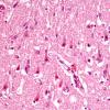 7A2 Hypoxia-Ischemia (Case 7) H&E 1