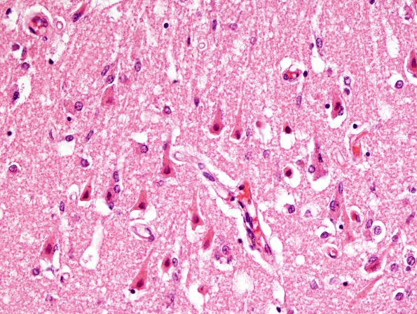 7A2 Hypoxia-Ischemia (Case 7) H&E 1