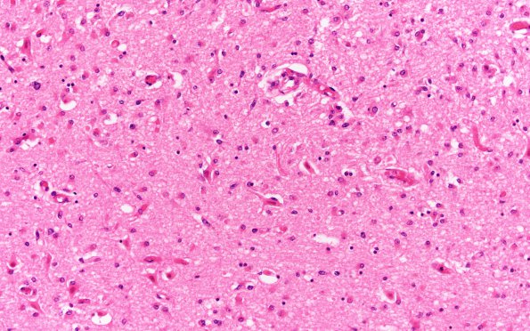 7A3 Hypoxia-Ischemia, N3 (Case 7)  CA4 H&E 20X