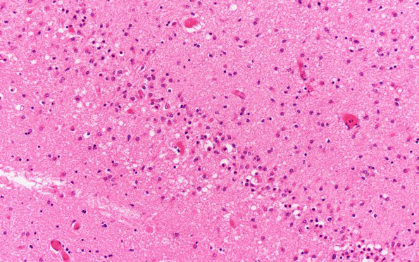 7A4 Hypoxia-Ischemia, N3 (Case 7) H&E 20X dentate