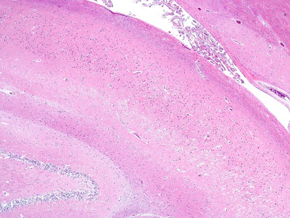 9A1 Hypoxia-Ischemia (Case 9) H&E 1