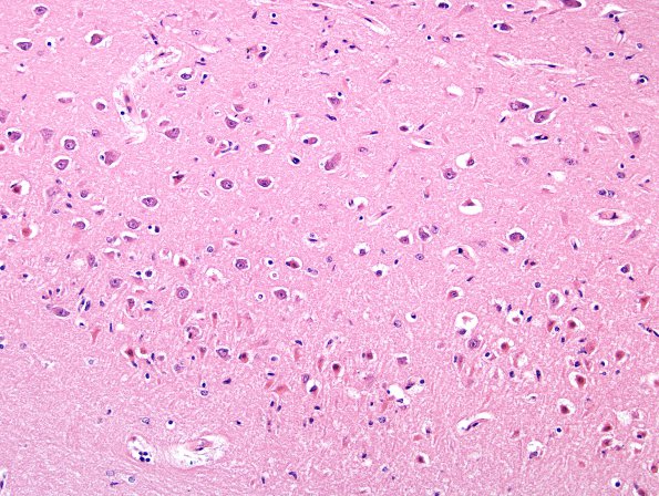 9A2 Hypoxia-Ischemia (Case 9) H&E 2