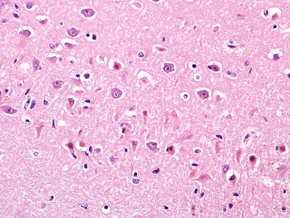 9A3 Hypoxia-Ischemia (Case 9) H&E 3