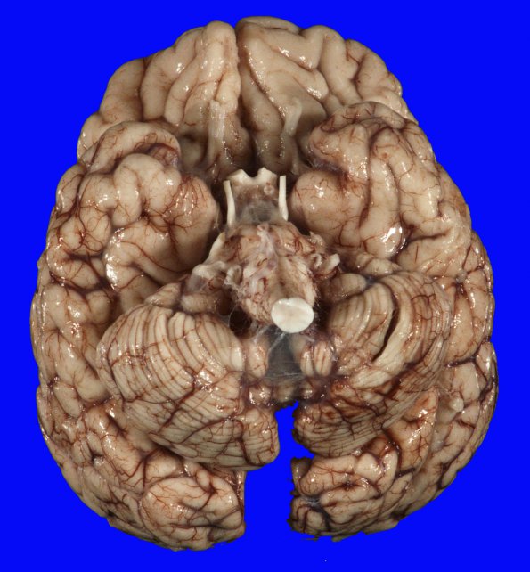 2A1 Hypoxia-ischemia neonatal (Case 2) 1