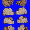 2A2 Hypoxia-ischemia neonatal (Case 2) 10