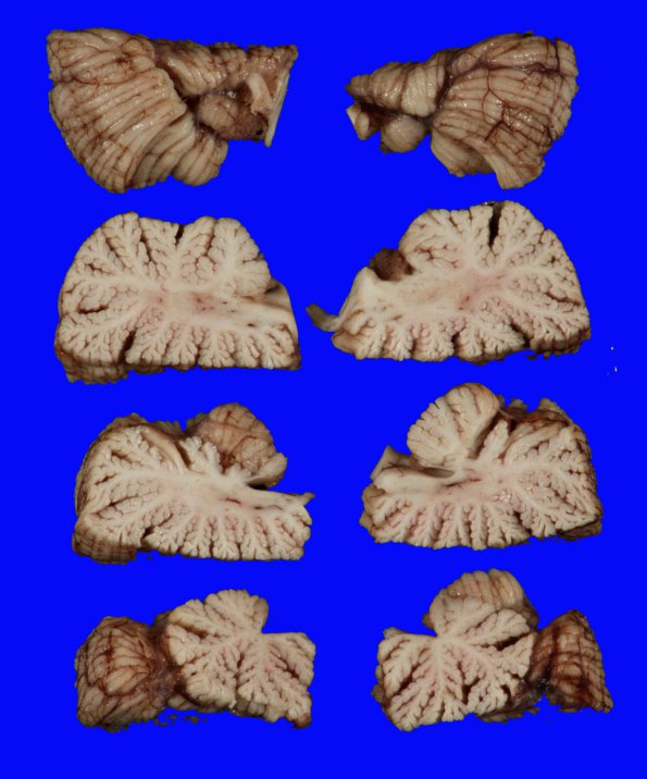 2A2 Hypoxia-ischemia neonatal (Case 2) 10