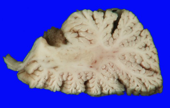 2A3 Hypoxia-ischemia neonatal (Case 2) 11