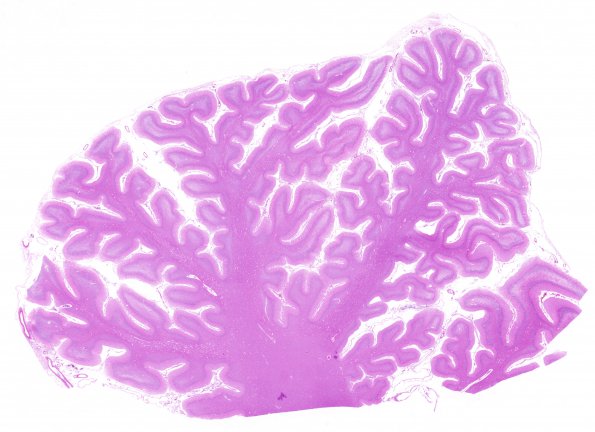 2B1 Hypoxia-ischemia neonatal (Case 2) N16 H&E WM