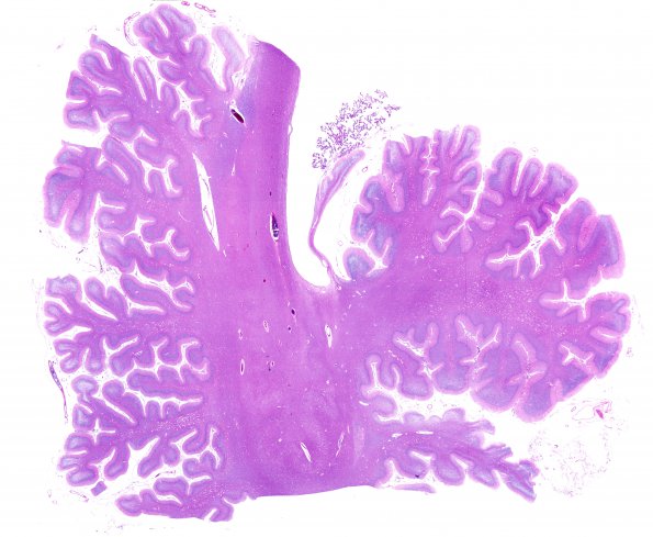 2B2 Hypoxia-ischemia neonatal (Case 2) N15 H&E WM