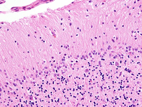 2B3 Hypoxia-ischemia neonatal (Case 2) N15 H&E 1