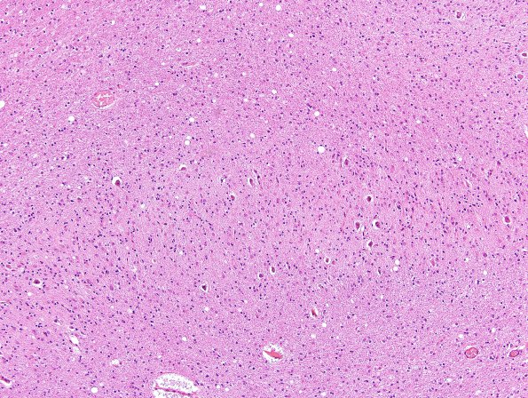 2B4 Hypoxia-ischemia neonatal (Case 2) N15 H&E 3 (dentate)