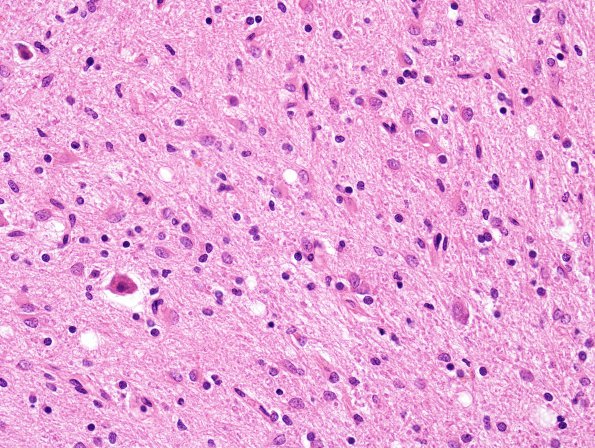 2B5 Hypoxia-ischemia neonatal (Case 2) N15 H&E 1 (dentate)