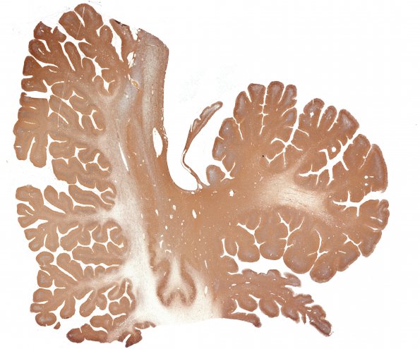 2D1 Hypoxia-ischemia neonatal (Case 2) N15 1 GFAP whole mount