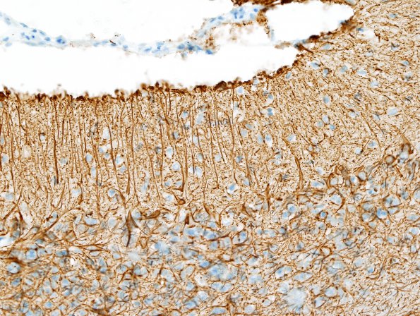 2D2 Hypoxia-ischemia neonatal (Case 2) N15 GFAP 3