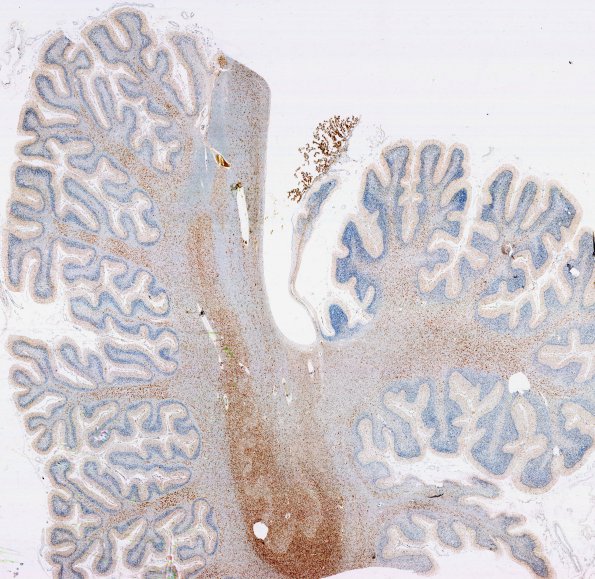 2E1 Hypoxia-ischemia neonatal (Case 2) N15 1 CD68 whole mount