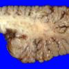 3A2 Hypoxia Ischemia, neonatal (Case 3) 4