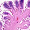 3B1 Hypoxia Ischemia, Cbell (Case 3) H&E 1