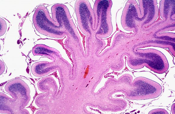 3B1 Hypoxia Ischemia, Cbell (Case 3) H&E 1