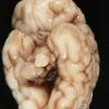 4A1 Hypoxia-Ischemia, neonatal, cerebellum (Case 4) gross_1