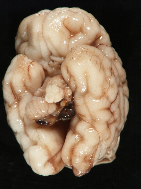 4A1 Hypoxia-Ischemia, neonatal, cerebellum (Case 4) gross_1