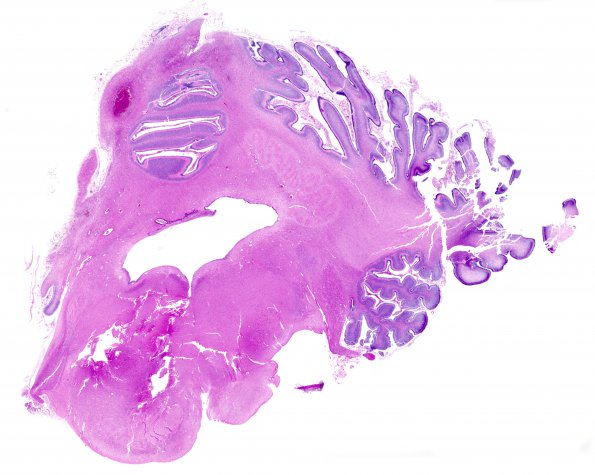 4B1 Hypoxia-Ischemia, Neonatal, (Case 4) N8 H&E  WM