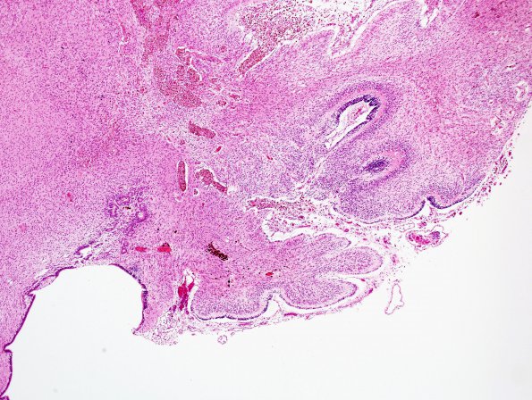 4B3 Hypoxia-Ischemia, Neonatal, (Case 4) N10 H&E 6