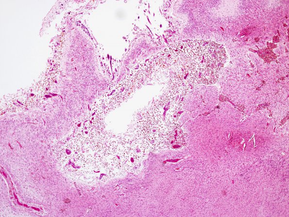 4B4 Hypoxia-Ischemia, Neonatal, (Case 4) N10 H&E 5