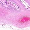 4B5 Hypoxia-Ischemia, Neonatal, (Case 4) N8 H&E 2