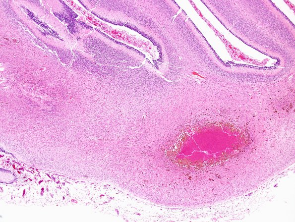 4B5 Hypoxia-Ischemia, Neonatal, (Case 4) N8 H&E 2