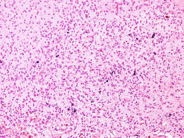 4B7 Hypoxia-Ischemia, Neonatal, (Case 4) N10 H&E 3