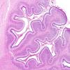 4B8 Hypoxia-Ischemia, Neonatal, (Case 4) N8 H&E 1