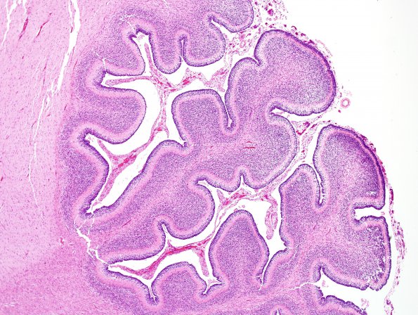 4B8 Hypoxia-Ischemia, Neonatal, (Case 4) N8 H&E 1