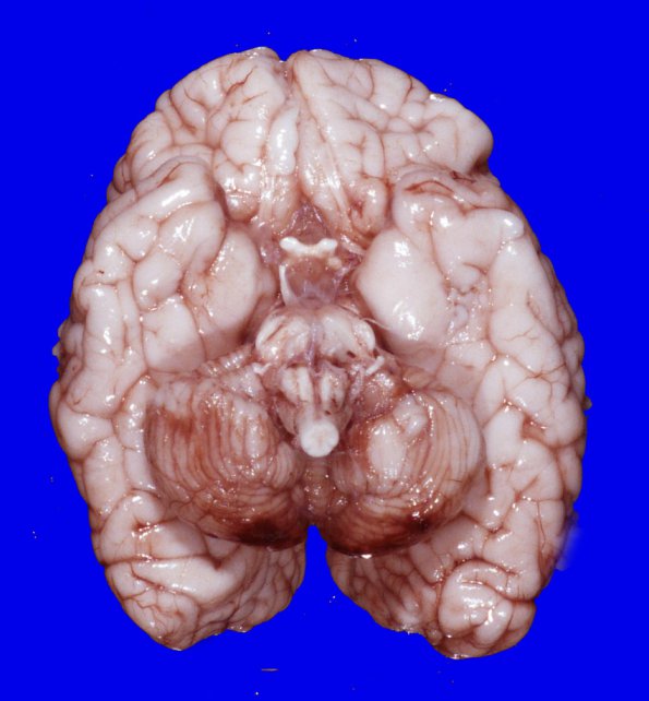 5A1 H-I, neonatal, HLH, noHIV (Case 5) H&E WM