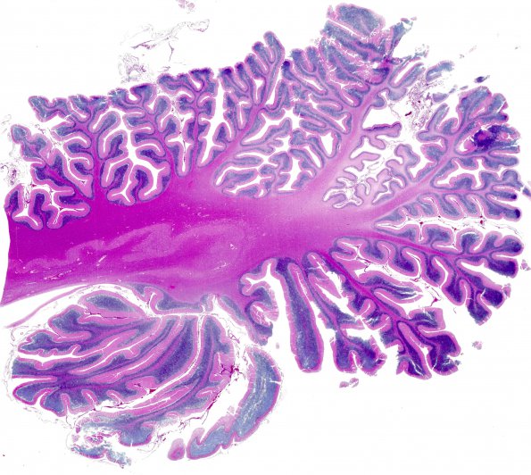 5B1 H-I, neonatal, HLH, noHIV (Case 5) H&E WM