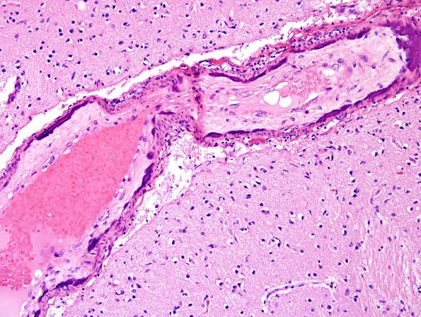 5B2 H-I, neonatal, HLH, noHIV (Case 5) N2 H&E 5