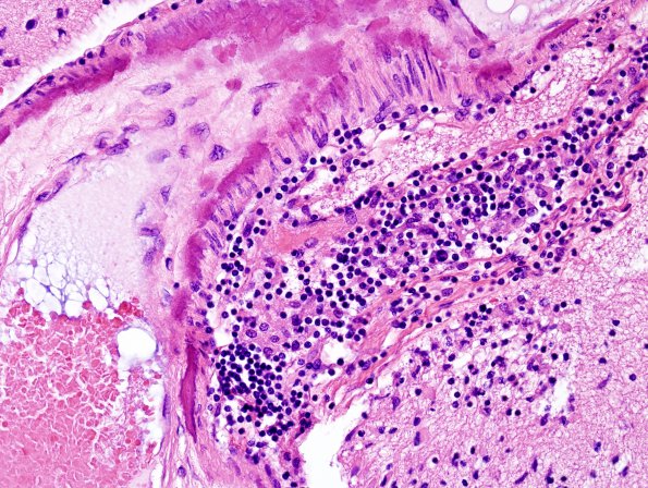 5B3 H-I, neonatal, HLH, noHIV (Case 5) H&E 10