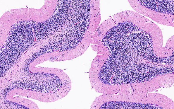 5B4 H-I, neonatal, HLH, noHIV (Case 5) N9 H&E 1