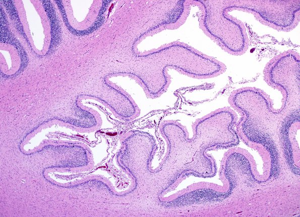 5B5 H-I, neonatal, HLH, noHIV (Case 5) N9 H&E 11