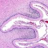 5B6 H-I, neonatal, HLH, noHIV (Case 5) N9 H&E 12