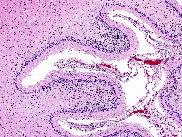 5B6 H-I, neonatal, HLH, noHIV (Case 5) N9 H&E 12