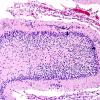 5B7 H-I, neonatal, HLH, noHIV (Case 5) N9 H&E 13