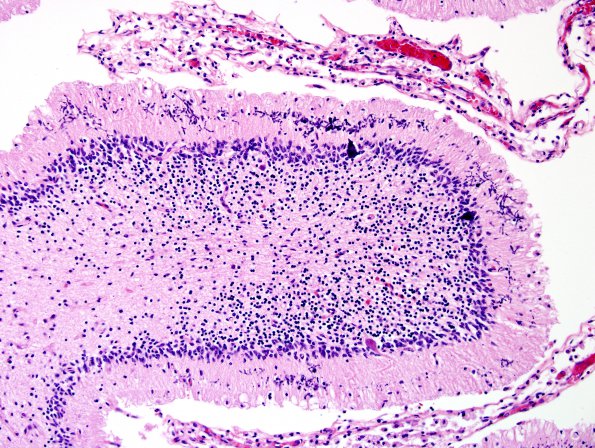 5B7 H-I, neonatal, HLH, noHIV (Case 5) N9 H&E 13